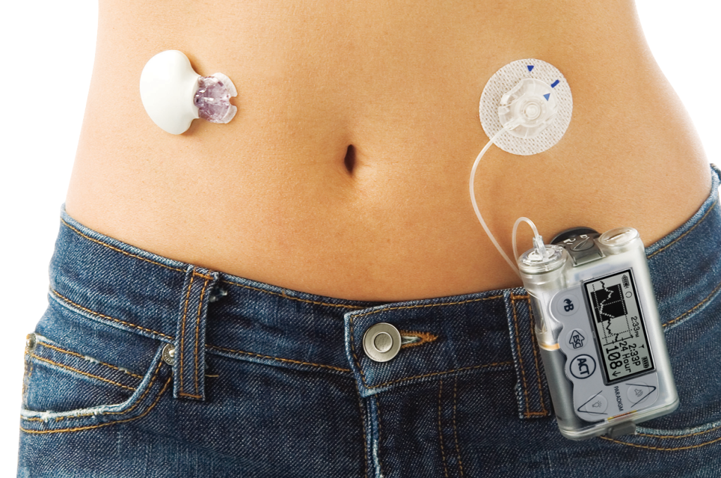 Image of a Medtronic glucose monitor and insulin pump.